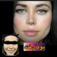 ساکشن غبغب بوکال فت بلفارو پیکر تراشی کاشت ابرو|خدمات آرایشگری و زیبایی|تهران, پونک|دیوار