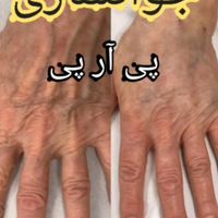 معجزه جوانسازی با پی آر پی در مطب|خدمات آرایشگری و زیبایی|قم, امام|دیوار