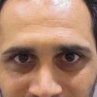 کاشت مو و‌یک جلسه مزوتراپی یک جلسه پی آر پی رایگان|خدمات آرایشگری و زیبایی|تهران, جردن|دیوار