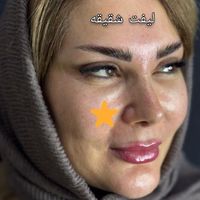لیفت شقیقه بلفاروپلاستی|خدمات آرایشگری و زیبایی|تهران, میرداماد|دیوار