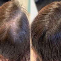 تزریق ژل بوتاکس فیلر مزوتراپی|خدمات آرایشگری و زیبایی|کرج, گوهردشت|دیوار
