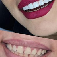 کامپوزیت دندان /لمینیت/وتمامی خدمات دندان پزشکی|خدمات آرایشگری و زیبایی|تهران, فرمانیه|دیوار
