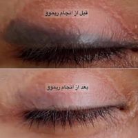 ریموو تَتوی صورت تنها در یک جلسه و بدون درد|خدمات آرایشگری و زیبایی|تهران, قیطریه|دیوار