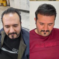 کاشت مو تبریز|خدمات آرایشگری و زیبایی|ارومیه, |دیوار