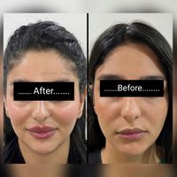 تزریق ژل لب و گونه و چانه و..(جشنواره)درمطب|خدمات آرایشگری و زیبایی|اصفهان, ملک‌شهر|دیوار