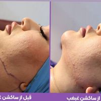 جشنواره ی تخفیف بلفاروپلاستی پلک و ساکشن غبغب|خدمات آرایشگری و زیبایی|تهران, سعادت‌آباد|دیوار
