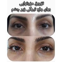 ژل بوتاکس ۳۹۰/ فیلربینی زیرچشم/لیفت صورت شقیقه/نخ|خدمات آرایشگری و زیبایی|تهران, فدک|دیوار