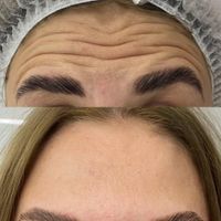 تزریق ژل بوتاکس فیلر مزوتراپی|خدمات آرایشگری و زیبایی|کرج, گوهردشت|دیوار