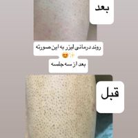 لیزر موهای زائد در نازی آباد ***********|خدمات آرایشگری و زیبایی|تهران, نازی‌آباد|دیوار