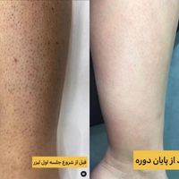 لیزر موهای زائدخانمها و آقایان ۳۹۰|خدمات آرایشگری و زیبایی|تهران, صادقیه|دیوار