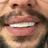 ایمپلنت و کامپوزیت زیبایی دندانپزشکی|خدمات آرایشگری و زیبایی|تهران, افسریه|دیوار
