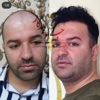 کاشت مو با جدیدترین متد روز دنیا|خدمات آرایشگری و زیبایی|تهران, عباس‌آباد|دیوار