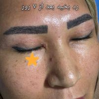 لیفت شقیقه بلفاروپلاستی|خدمات آرایشگری و زیبایی|تهران, میرداماد|دیوار