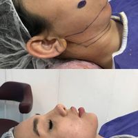 جشنواره ی تخفیف بلفاروپلاستی پلک و ساکشن غبغب|خدمات آرایشگری و زیبایی|تهران, سعادت‌آباد|دیوار