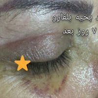 لیفت شقیقه بلفاروپلاستی|خدمات آرایشگری و زیبایی|تهران, میرداماد|دیوار