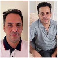 کاشت مو و‌یک جلسه مزوتراپی یک جلسه پی آر پی رایگان|خدمات آرایشگری و زیبایی|تهران, جردن|دیوار