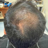 پی ار پی مو،صورت،اگزوزوم،مزوتراپی،هیرفیلر PRP|خدمات آرایشگری و زیبایی|تهران, هفت حوض|دیوار