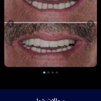 ایمپلنت  فوری.اوردنچر .عصب کشی ،ترمیم پوسیدگی|خدمات آرایشگری و زیبایی|تهران, تهرانپارس غربی|دیوار