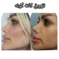 ژل بوتاکس ۳۹۰/ فیلربینی زیرچشم/لیفت صورت شقیقه/نخ|خدمات آرایشگری و زیبایی|تهران, فدک|دیوار