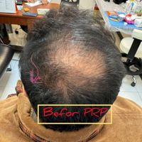 پی ار پی مو،صورت،اگزوزوم،مزوتراپی،هیرفیلر PRP|خدمات آرایشگری و زیبایی|تهران, هفت حوض|دیوار