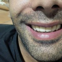 دندان مصنوعی (دست دندان)|آرایشی، بهداشتی، درمانی|تهران, صفا|دیوار