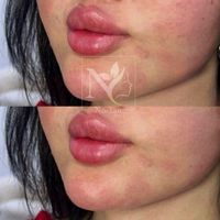 تزریق ژل و بوتاکس و مدلینگ عربی در جشنواره50%|خدمات آرایشگری و زیبایی|تهران, قیطریه|دیوار