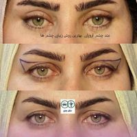 برداشتن پف بالا و پایین چشم متداروپایی|خدمات آرایشگری و زیبایی|اصفهان, جلفا|دیوار