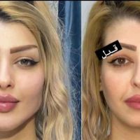 آموزش ژل بوتاکس نخ مدل پزشک هایفو آنزیم مزوتراپی|خدمات آرایشگری و زیبایی|تهران, ستارخان|دیوار