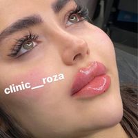 مدل تزریق ژل فیلر کانتورینگ عربی لب روسی|خدمات آرایشگری و زیبایی|کرج, گوهردشت|دیوار