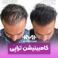 افر استثنایی خدمات زیبایی تزریق ژل و لیزر و فیشال|خدمات آرایشگری و زیبایی|تهران, سعادت‌آباد|دیوار