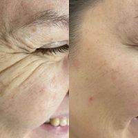 تزریق ژل بوتاکس فیلر مزوتراپی|خدمات آرایشگری و زیبایی|کرج, گوهردشت|دیوار