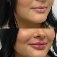جشنواره تزریق ژل فیلر و بوتاکس و پی آر پی ( PRP )|خدمات آرایشگری و زیبایی|تهران, جنت‌آباد جنوبی|دیوار