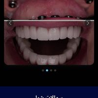 ایمپلنت  فوری.اوردنچر .عصب کشی ،ترمیم پوسیدگی|خدمات آرایشگری و زیبایی|تهران, تهرانپارس غربی|دیوار
