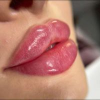ژل بوتاکس لیزر مزو پی آر پی خالیرداری جوانسازی|خدمات آرایشگری و زیبایی|تهران, افسریه|دیوار