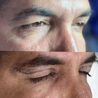جشنواره ی تخفیف بلفاروپلاستی پلک و ساکشن غبغب|خدمات آرایشگری و زیبایی|تهران, سعادت‌آباد|دیوار