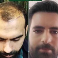 درمان ریزش مو و رویش مجدد کاملا تضمینی|خدمات آرایشگری و زیبایی|اصفهان, باغ زیار|دیوار