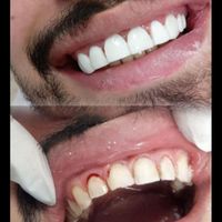 کامپوزیت زیبایی دندان( مدل) فقط توسط دندانپزشک|خدمات آرایشگری و زیبایی|تهران, صادقیه|دیوار
