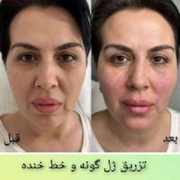 تزریق ژل و بوتاکس با مجوز وزارت بهداشت و درمان|خدمات آرایشگری و زیبایی|تهران, نارمک|دیوار