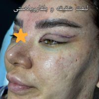 لیفت شقیقه بلفاروپلاستی|خدمات آرایشگری و زیبایی|تهران, میرداماد|دیوار