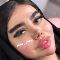 مدل تزریق ژل فیلر کانتورینگ عربی لب روسی|خدمات آرایشگری و زیبایی|کرج, گوهردشت|دیوار