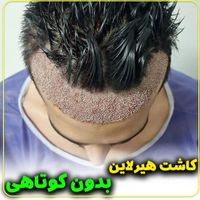 کاشت مو ، کاشت ابرو و کاشت ریش|خدمات آرایشگری و زیبایی|تهران, اندیشه (شهر زیبا)|دیوار