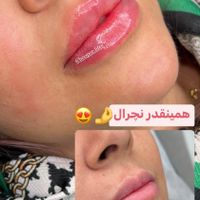 مدل برای تزریق   ژل لب، صورت|خدمات آرایشگری و زیبایی|تهران, زعفرانیه|دیوار