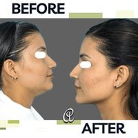 جراحی رفع غبغب لیپوساکشن اندولیفت و بوکال فت|خدمات آرایشگری و زیبایی|تهران, شهرک غرب|دیوار