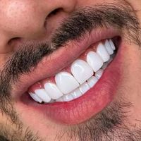 کامپوزیت  لمینت   لیرینگ|خدمات آرایشگری و زیبایی|تهران, هروی|دیوار
