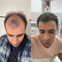 کاشت مو تبریز|خدمات آرایشگری و زیبایی|ارومیه, |دیوار