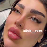 مدل تزریق ژل فیلر کانتورینگ عربی لب روسی|خدمات آرایشگری و زیبایی|کرج, گوهردشت|دیوار