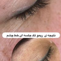 جشنواره تخفیفی ریموو تخصصی تتو تک جلسه ای|خدمات آرایشگری و زیبایی|قم, باجک (۱۹ دی)|دیوار