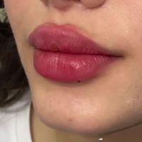 آموزش ژل بوتاکس نخ مدل پزشک هایفو آنزیم مزوتراپی|خدمات آرایشگری و زیبایی|تهران, ستارخان|دیوار