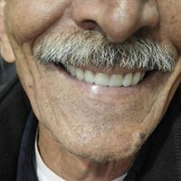دندان مصنوعی (دست دندان)|آرایشی، بهداشتی، درمانی|تهران, صفا|دیوار