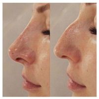 آموزش ژل بوتاکس نخ مدل پزشک هایفو آنزیم مزوتراپی|خدمات آرایشگری و زیبایی|تهران, ستارخان|دیوار